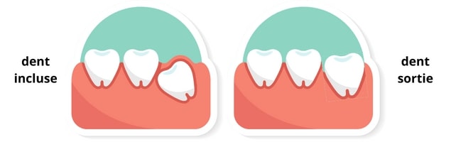 extraction dents de sagesse