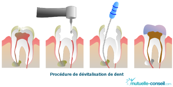 Dévitaliser une dent : procédure, prix et remboursement