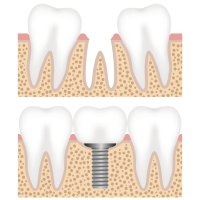 Implant dentaire