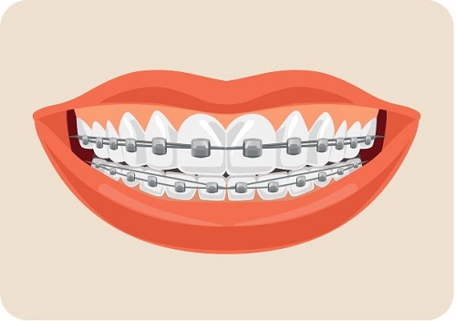 Appareil dentaire orthodontie