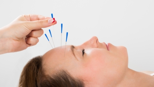 Remboursement de l’acupuncture : prise en charge par les assurances santé