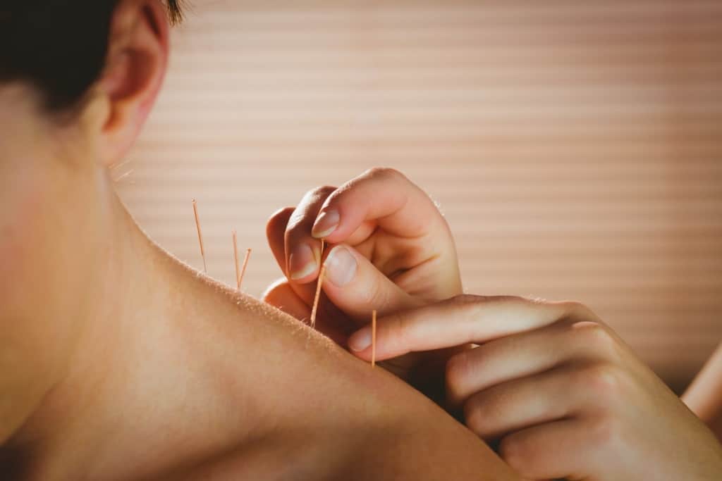 Remboursement Acupuncture : quelle prise en charge ?