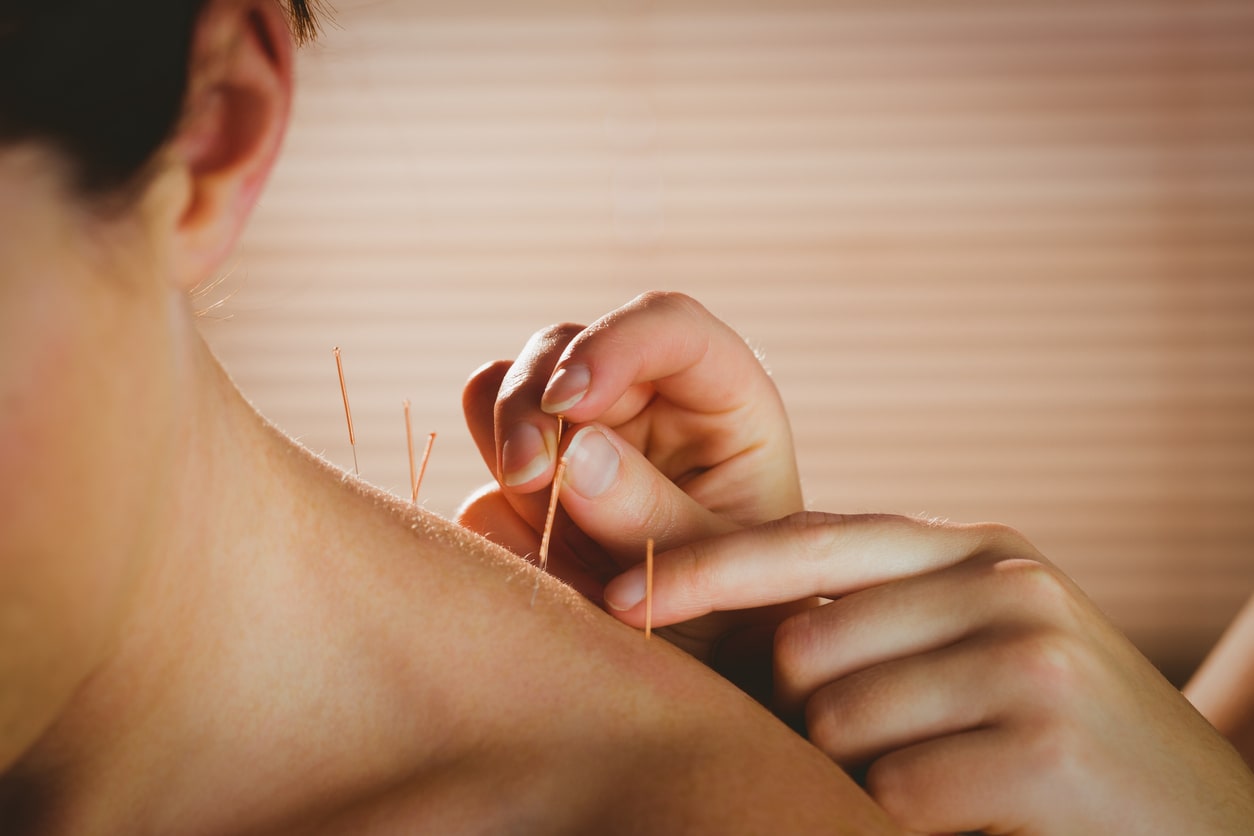 Remboursement Acupuncture : quelles prises en charge ?