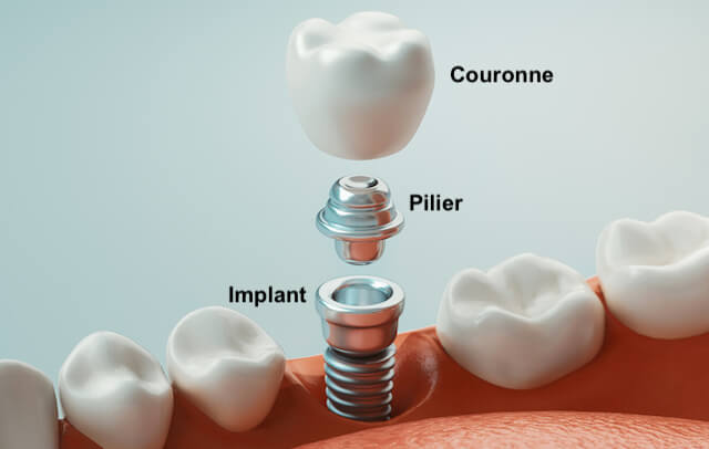 Prix et remboursement d'un implant dentaire