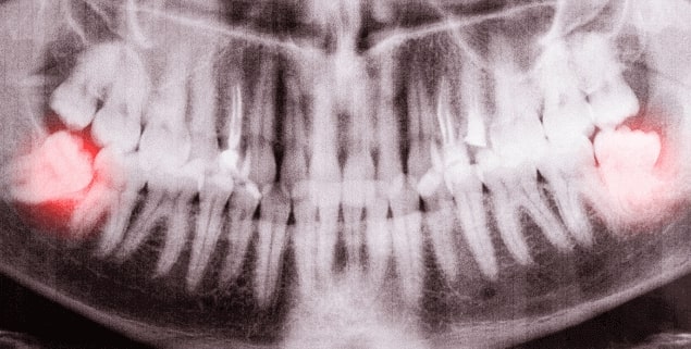 Quel est le prix d’une extraction des dents de sagesse ?