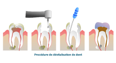 Dévitaliser une dent : procédure, prix et remboursement