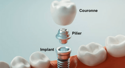 Prix et remboursement d'un implant dentaire